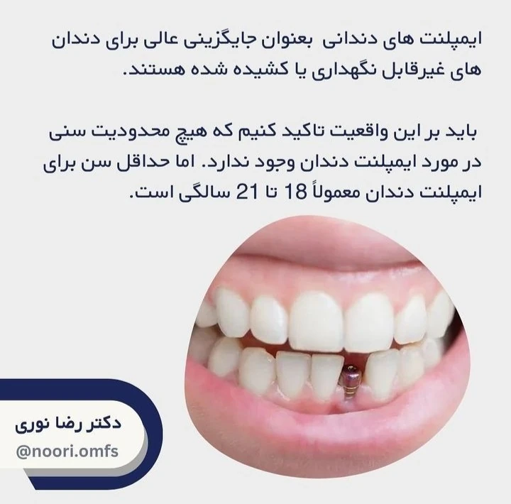 آیا انجام ایمپلنت‌های دندانی محدودیت سنی دارد؟