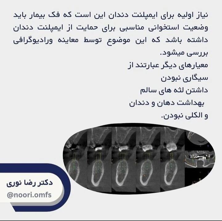 آیا انجام ایمپلنت‌های دندانی محدودیت سنی دارد؟