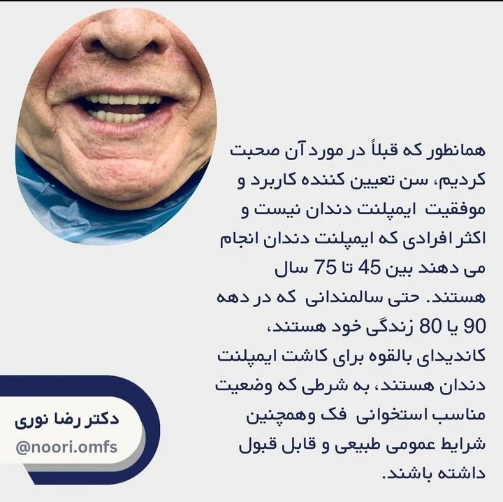 آیا انجام ایمپلنت‌های دندانی محدودیت سنی دارد؟