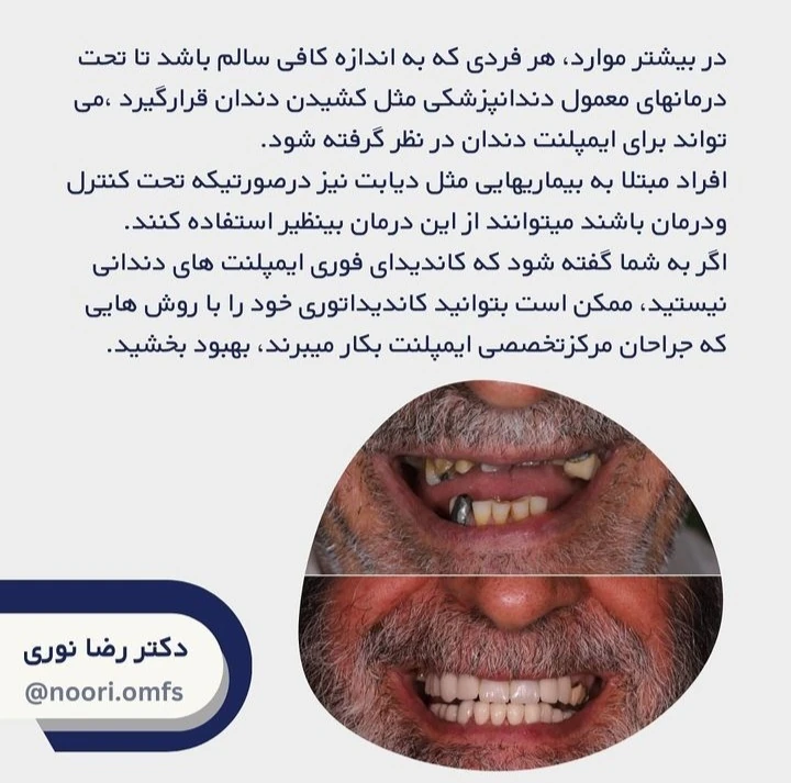 آیا همه افراد می‌توانند از درمان ایمپلنت بهره ببرند؟