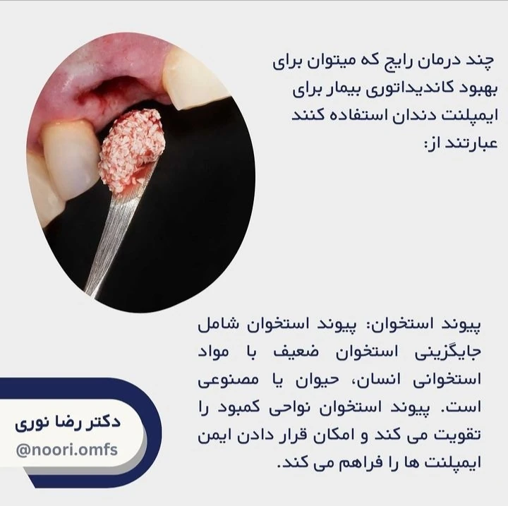 آیا همه افراد می‌توانند از درمان ایمپلنت بهره ببرند؟