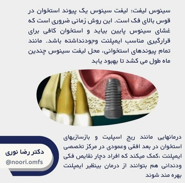 آیا همه افراد می‌توانند از درمان ایمپلنت بهره ببرند؟