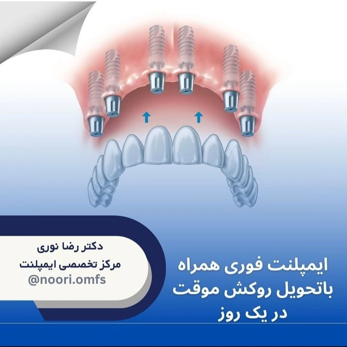 ایمپلنت فوری همراه با تحویل روکش موقت در یک روز