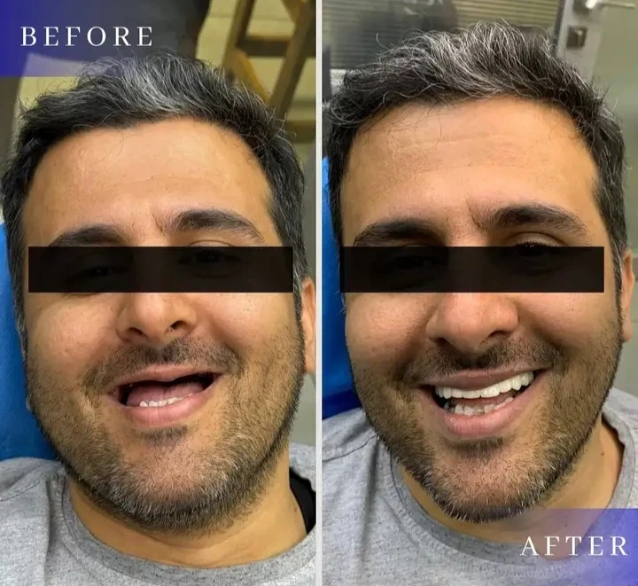 ایمپلنت با بیمه پارسیان